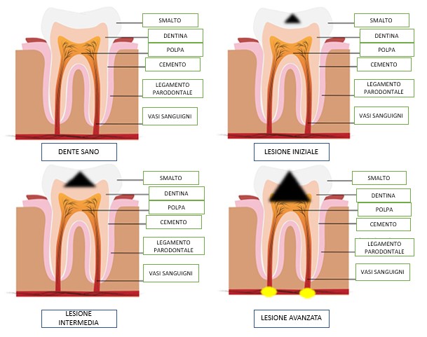 Credo di avere una carie ma il dente non mi fa male, posso stare tranquillo?